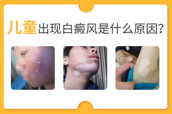 合肥兒童會因為什么原因而患上白癜風呢？